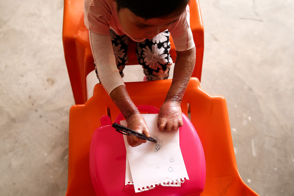 Aina Afieyah Muhamad Nazreen Syah, who was born with the rare skin condition Epidermolysis Bullosa (EB), is pictured at The 13th Rainbow of Life Force (ROLF) Gold Ribbon Grant-A-Campaign 2019 in Shah Alam September 30, 2019. 