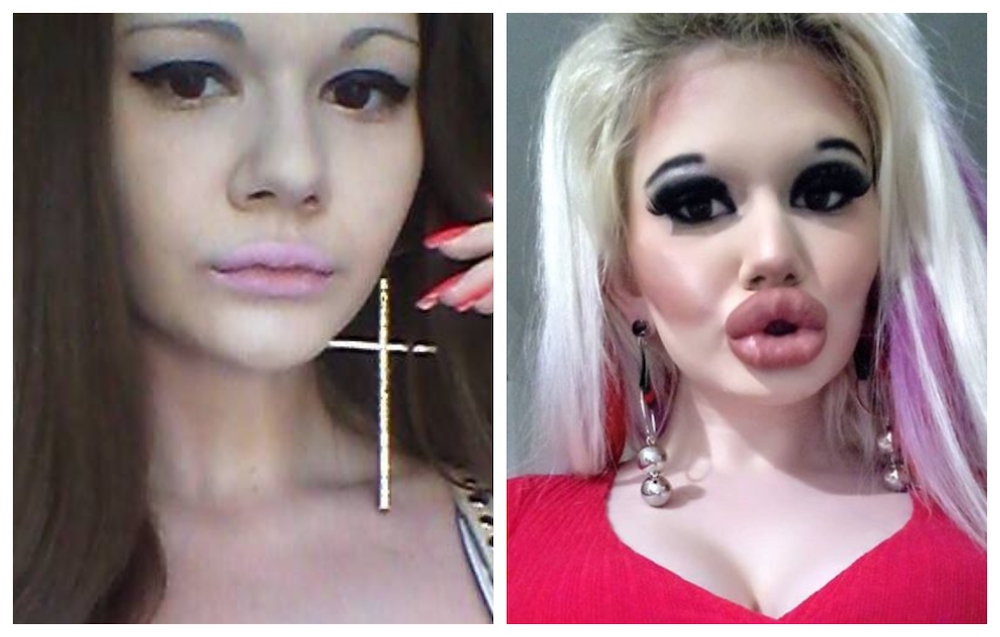 Andrea Emilova Ivanova before and after undergoing lips enlargement procedure. u00e2u20acu201d Picture via Facebook/andrea.ivanova.35