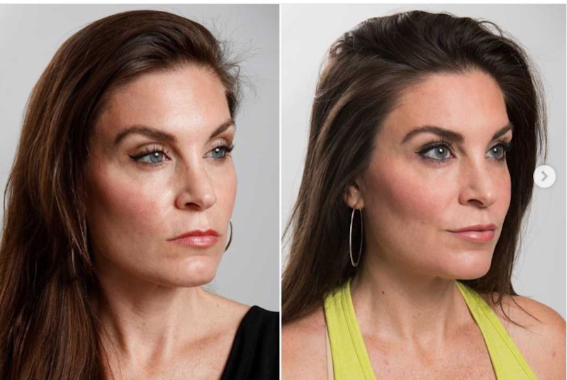 Hope Davis u00e2u20acu201d before and after botox procedure to fix her u00e2u20acu02dcresting bitch faceu00e2u20acu2122. u00e2u20acu201d Picture via Instagram/hope_d_hope