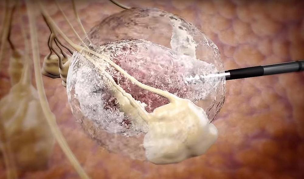 The formation of an ice ball engulfing a tumour. During cryoablation, a thin needle is inserted into a tumour (pictured as pinkish tissue in ball). u00e2u20acu201d Image courtesy of PanAsia Surgery Group via TODAY