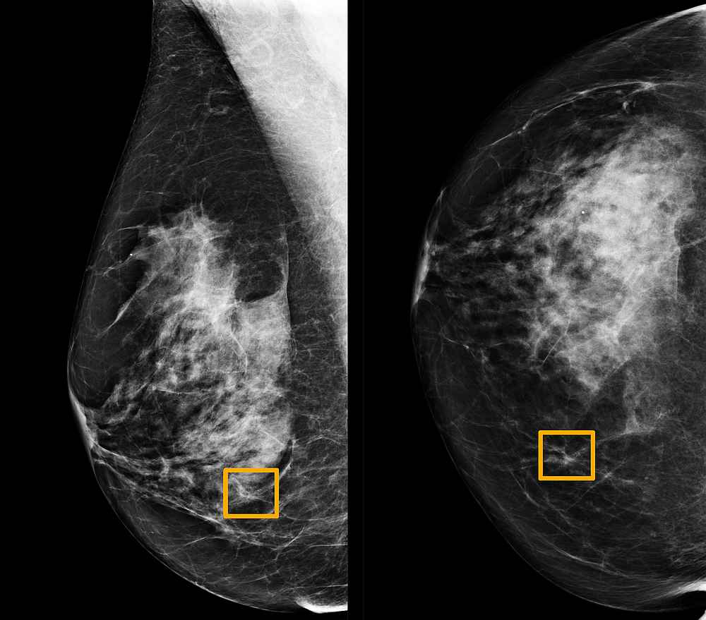 A yellow box indicates where an artificial intelligence (AI) system found cancer hiding inside breast tissue in this undated photo released January 1, 2020. u00e2u20acu201d Northwestern University handout via Reuters 