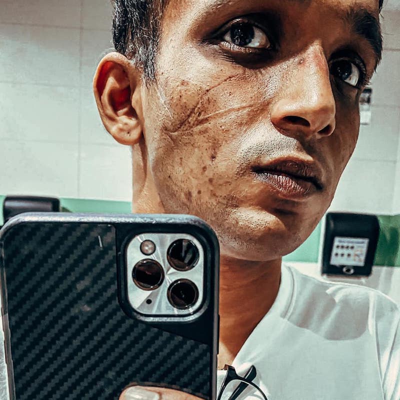 Wearing protective gear all day has left Ongu00e2u20acu2122s face with deep creases. u00e2u20acu201d Picture from Facebook/Benjamin.Ramki