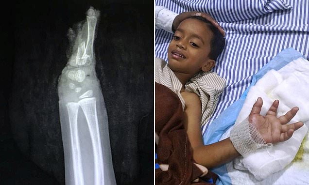 Four-year-old Shaurya Undre had to undergo a major surgery to fix back his amputated hand. u00e2u20acu201d Picture via Twitter/RushReads