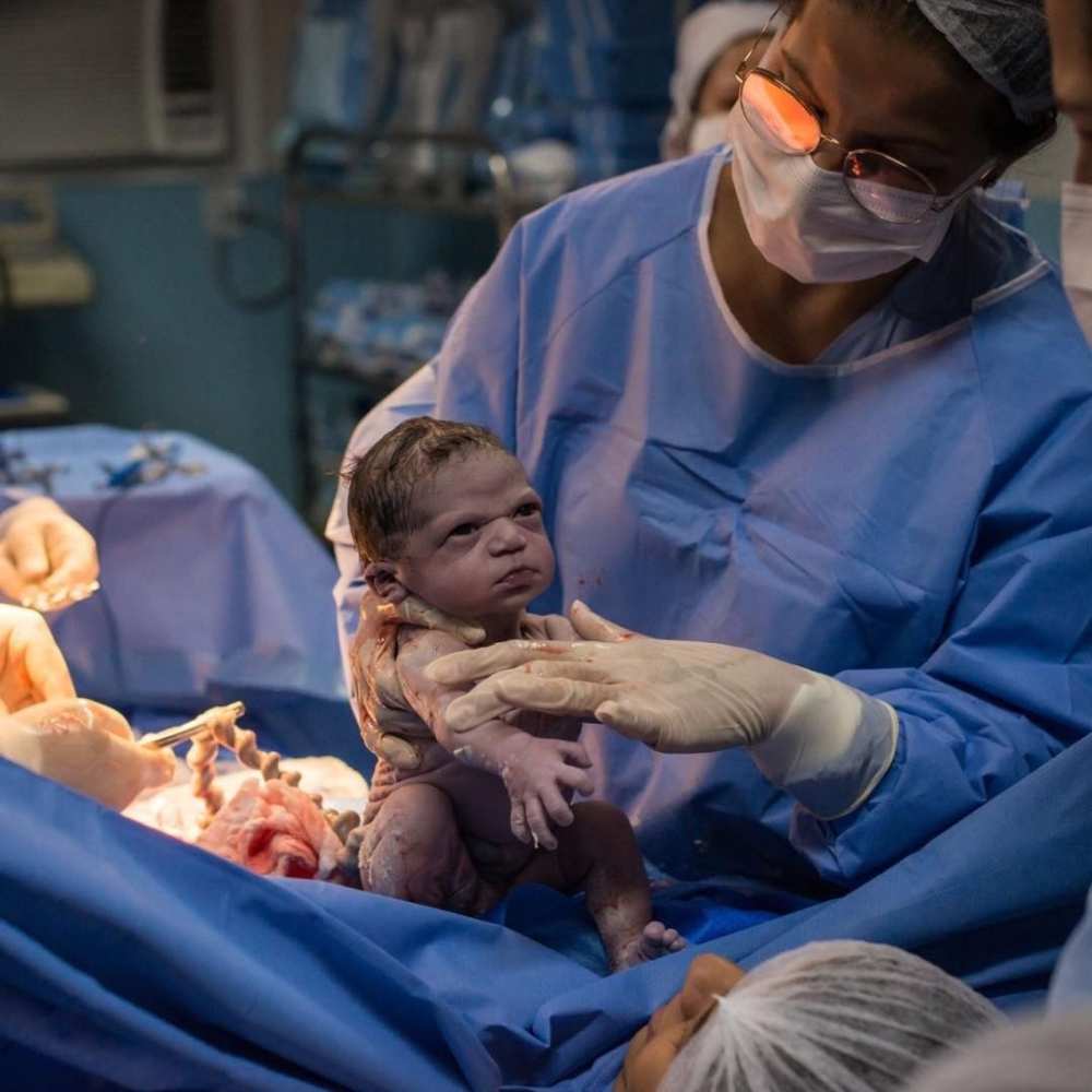 Isabela Pereira de Jesus stared down at doctors moments after she was born via Caesarean section on February 13 at a Rio de Janeiro hospital in Brazil. u00e2u20acu2022 Picture via Instagram/ isa_bravinha1