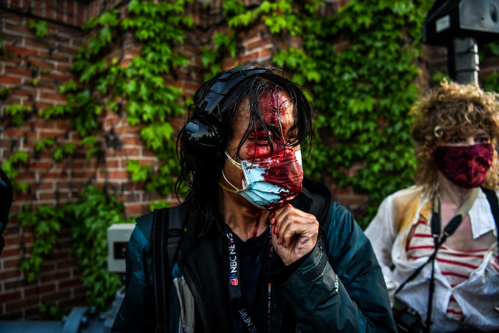 A journalist is seen bleeding after police started firing tear gas and rubber bullets following a demonstration to call for justice for George Floyd in Minneapolis, Minnesota May 30, 2020. u00e2u20acu201d AFP pic