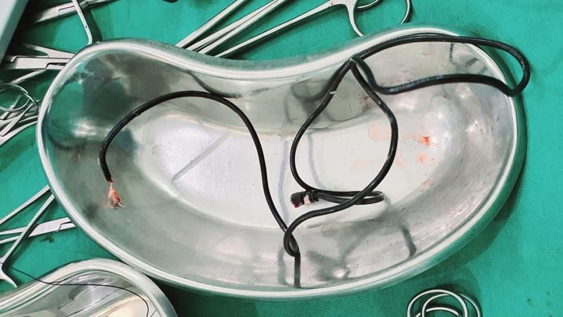 A look at the removed cable. — Picture via Facebook/Wallie Islam 