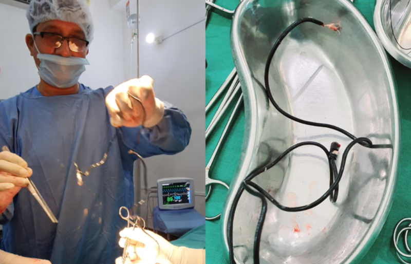 Dr Walliul couldnu00e2u20acu2122t believe that the patient had inserted the 61-centimetre-long cable into his penis. u00e2u20acu201d Picture via Facebook/Wallie Islam. 