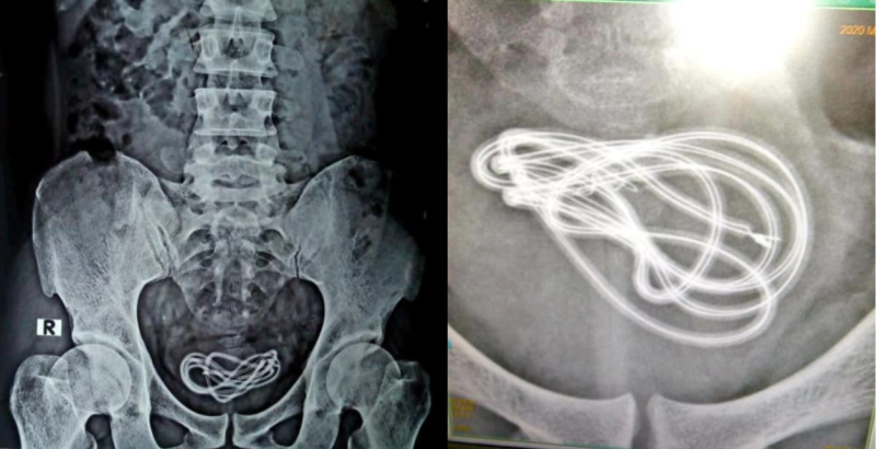 Dr Walliul couldn’t believe that the patient had inserted the 61-centimetre-long cable into his penis. — Picture via Facebook/Wallie Islam. 