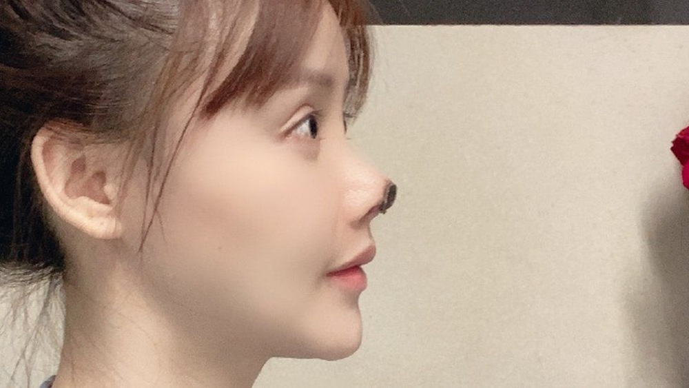Gao Liu posted candid pictures of her post-surgery face on the Weibo platform, which showed a part of her nose blackened with dead flesh. u00e2u20acu201d Picture via Weibo/Gao Liu