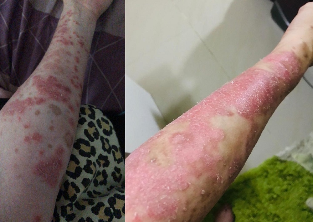 People living with psoriasis frequently encounter stigma, and discrimination, leading to lost opportunities, broken relationships and end up marginalised. — Pictures courtesy of Marsitah Mansor