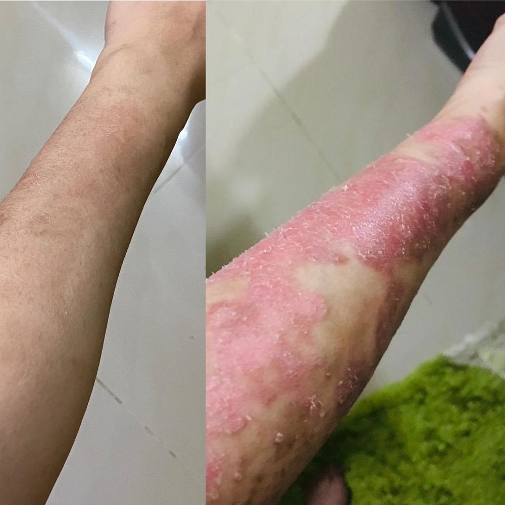 Marsitah’s psoriasis is now almost 95 per cent clear, allowing her to rebuild her self-esteem and take back control of her life. — Pictures courtesy of Marsitah Mansor