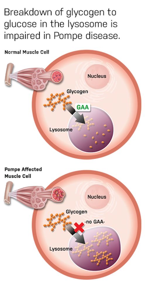 This graphic shows how the breakdown of glycogen in the lysosome is impaired in individuals with Pompe disease. — Picture courtesy of Dr Ngu Lock Hock