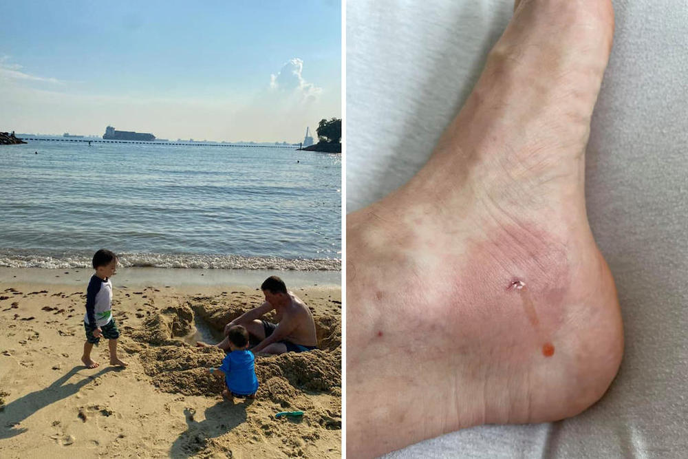 Benjamin Koellmann, a German national and personalised employment pass holder, was stung by a stingray at Tanjong Beach. u00e2u20acu201d Picture by Benjamin Koellman