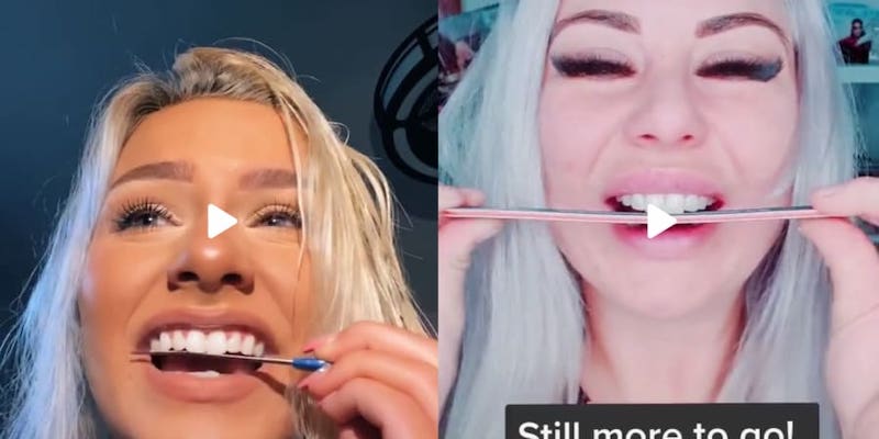 This TikTok trick, which involves filing down your teeth with a nail file, went viral in 2020, even though it turns out to be dangerous. u00e2u20acu201d Picture courtesy of acerendulicc / blayzewilliams / Tiktok