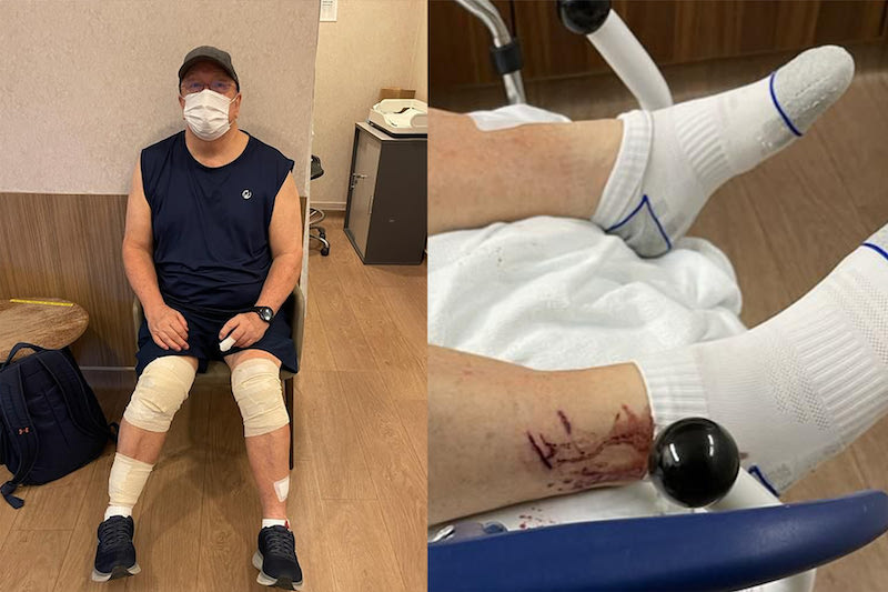 Graham George Spencer received treatment at Gleneagles Hospital after being bitten by otters at Singapore Botanic Gardens on November 30, 2021. u00e2u20acu201d Picture courtesy of Graham George Spencer via TODAY