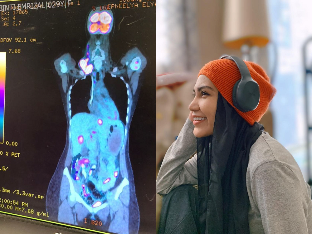 After over a decade battling lymphoma, cancer-stricken singer Elyana took to her Instagram to announce that sheu00e2u20acu2122s now cancer-free. u00e2u20acu201d Picture via Instagram/ Elyana Emrizal 