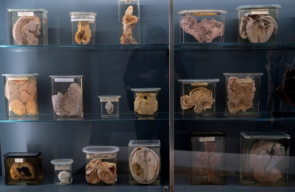 Exhibits of the anatomical pathology collection are displayed at Viennau00e2u20acu2122s prestigious u00e2u20acu02dcNarrenturmu00e2u20acu2122 Museum of Pathology in Vienna, Austria, on October 20, 2021. u00e2u20acu201d AFP pic