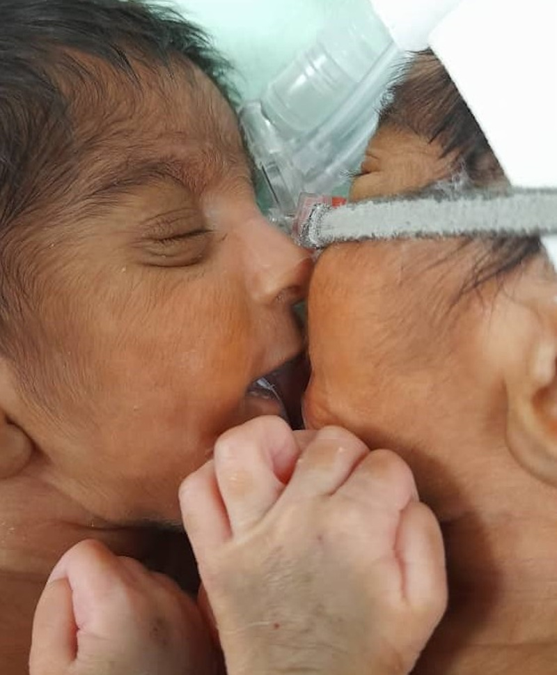 The premature conjoined twins before the historic surgery on Saturday. u00e2u20acu201d Picture courtesy of Deborah Anne Vince 