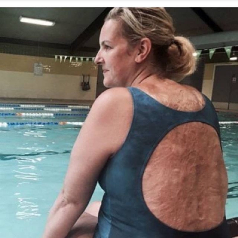 Sylvia Mac suffered from depression due to her scars but has since recovered and even walked London Fashion Week last year. u00e2u20acu2022 Picture via Facebook/ Sylvia Mac