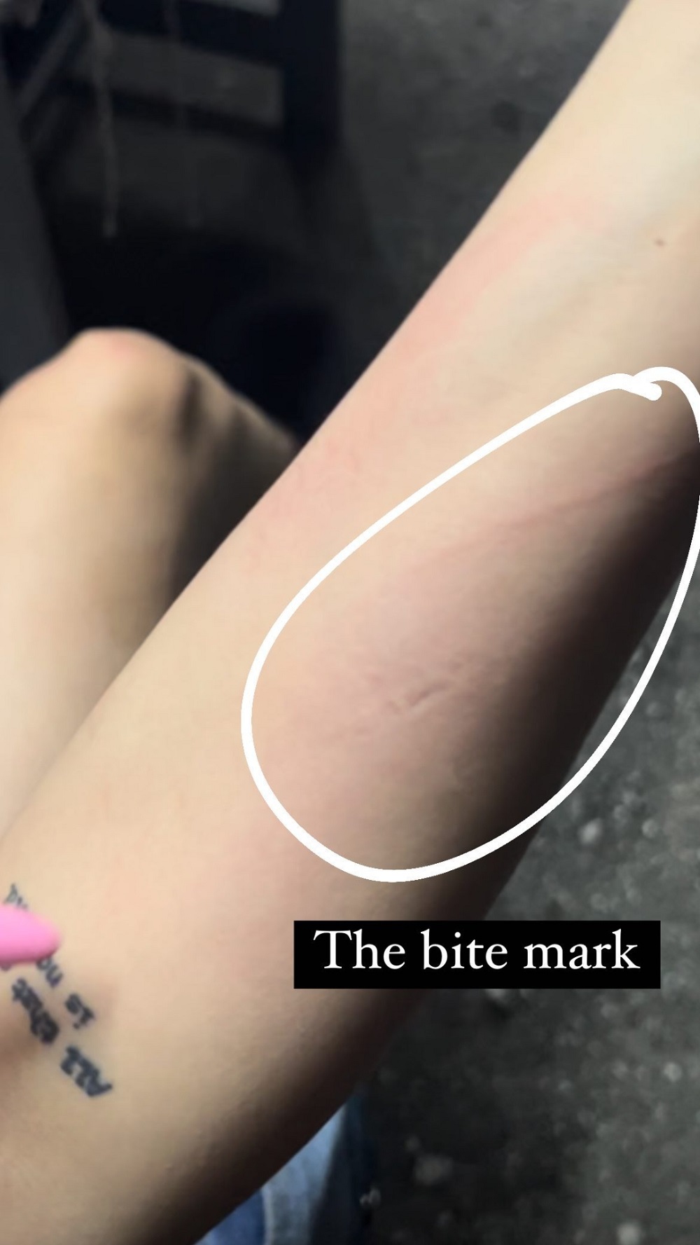 User @lucidsoda posted photos of bite marks from her encounter with the two men. ― Picture via Instagram/lucidsoda