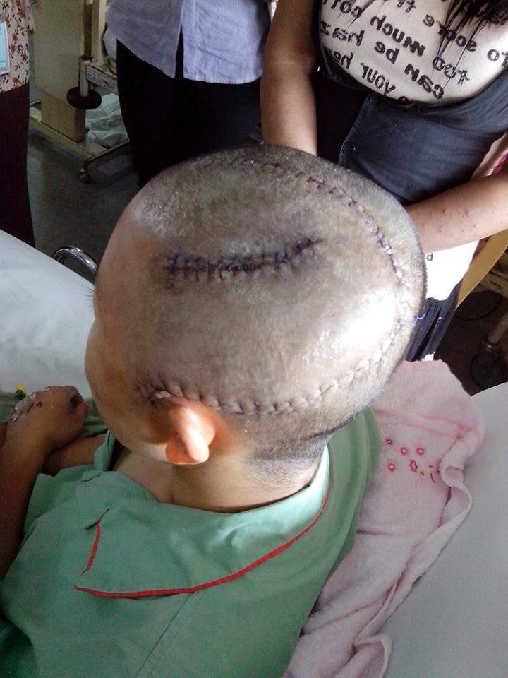 The ugly scars on Thai national Lilyu00e2u20acu2122s shaven head after she was assaulted by a group of youths armed with steel rods and hockey sticks. 
